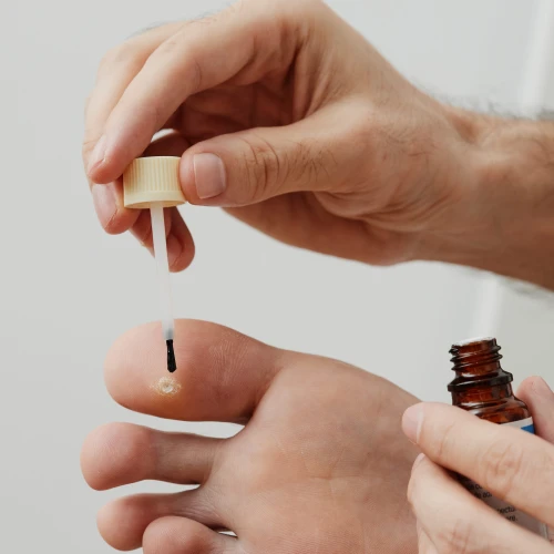 Förebyggande och borttagning av vårtor